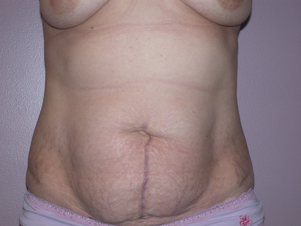 Abdominoplasty Patient 4 - Before
