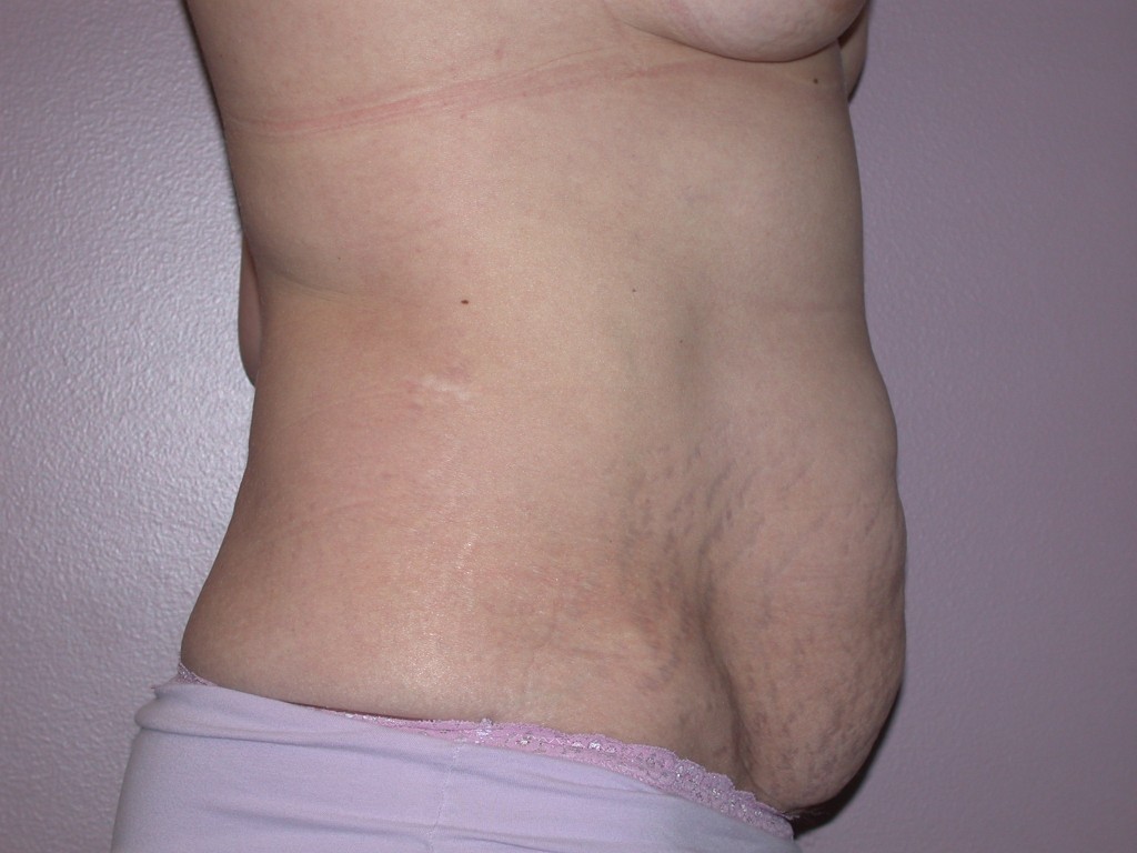 Abdominoplasty Patient 5 - Before