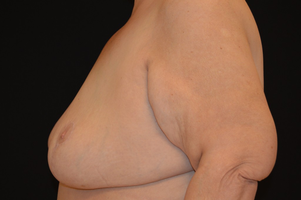 Breast Reduction Patient 5 - After