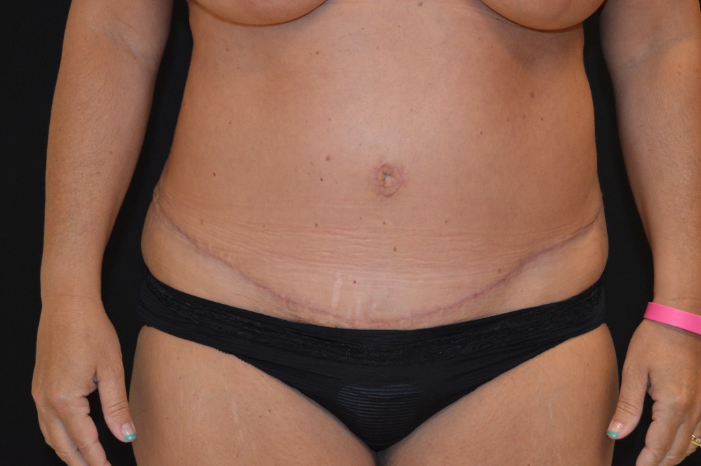 Abdominoplasty Patient 4 - After