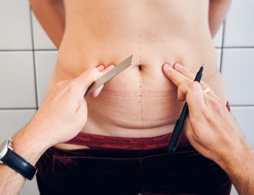 5 Facts About Tummy Tuck Surgery