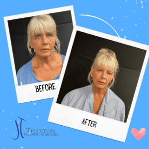 face filler before after Dr Rebecca Thaxton Charleston WV