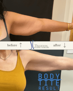 arms-before-and-after-body-tite-wv-2