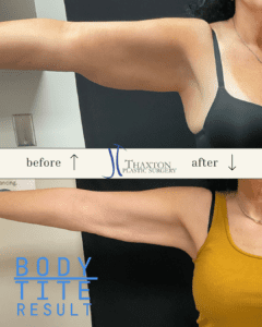 arms-before-and-after-body-tite-wv-2