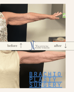 Brachioplasty arm lift surgery before and after