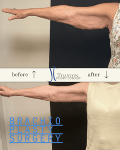 brachioplasty arm lift surgery before and after 