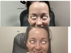 Botox before and after