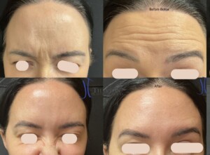 Botox before and after