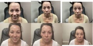 Botox before after 
